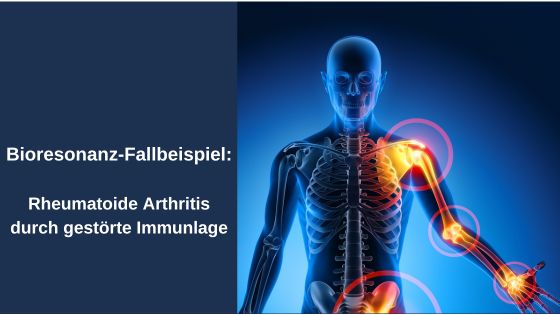 Bioresonanz-Fallbeispiel: Rheumatoide Arthritis durch gestörte Immunlage